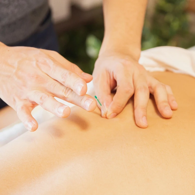 Dry needling practice