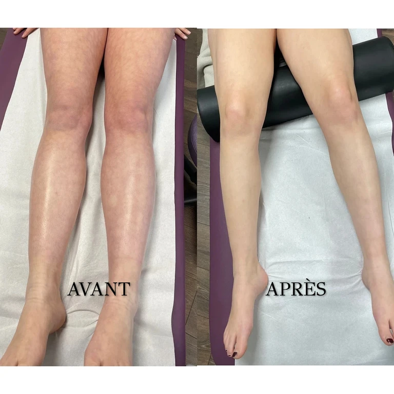 Fréquence recommandée des séances de drainage